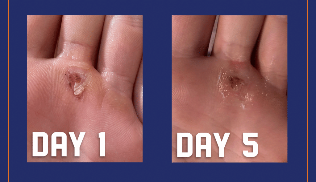 Don t Get Sidelined Prevent and Treat Baseball Blisters with DuraDerm SPORT